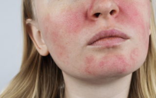 A lady with a flushed face