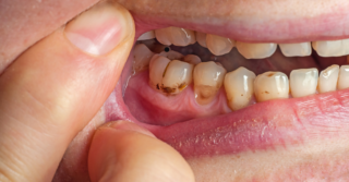 Close-up of a mouth with severe tooth decay and gum disease.